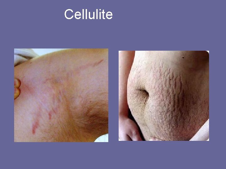 Cellulite 