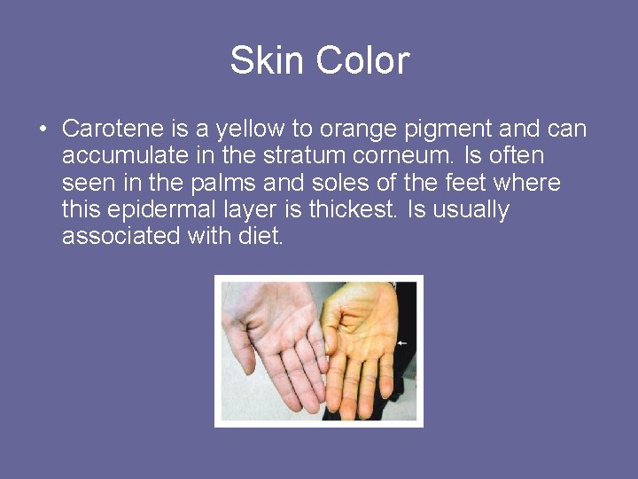 Skin Color • Carotene is a yellow to orange pigment and can accumulate in