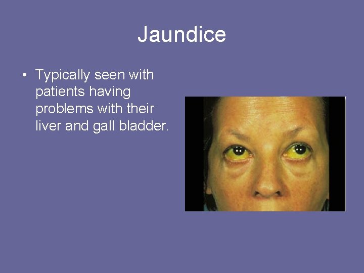 Jaundice • Typically seen with patients having problems with their liver and gall bladder.