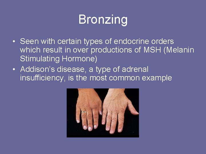 Bronzing • Seen with certain types of endocrine orders which result in over productions