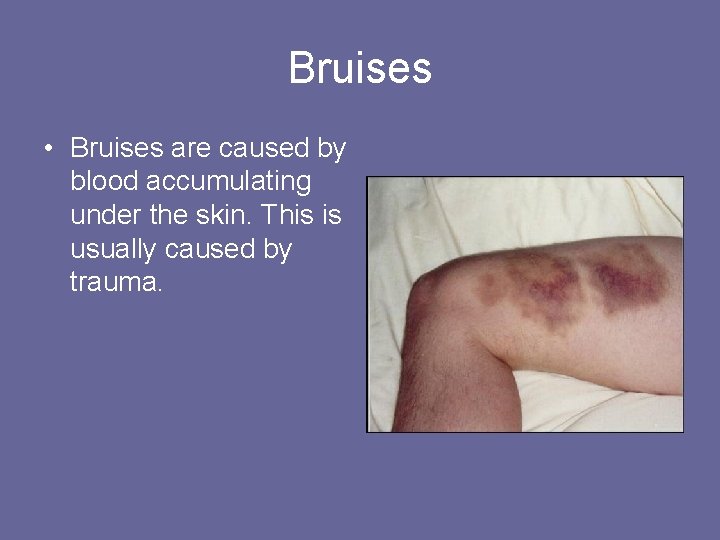 Bruises • Bruises are caused by blood accumulating under the skin. This is usually