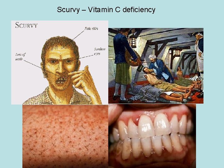 Scurvy – Vitamin C deficiency 