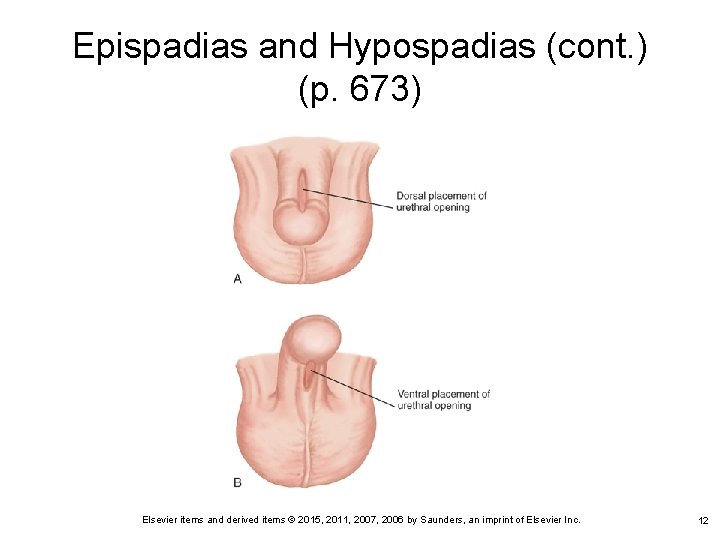 Epispadias and Hypospadias (cont. ) (p. 673) Elsevier items and derived items © 2015, Epispadias and Hypospadias (cont. ) (p. 673) Elsevier items and derived items © 2015,
