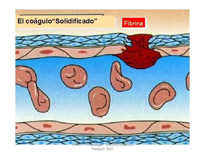 El coágulo“Solidificado” Fibrina IPCHILE - Kinesiologia DOCENTE: Veronica Pantoja S. 2014 El coágulo“Solidificado” Fibrina IPCHILE - Kinesiologia DOCENTE: Veronica Pantoja S. 2014