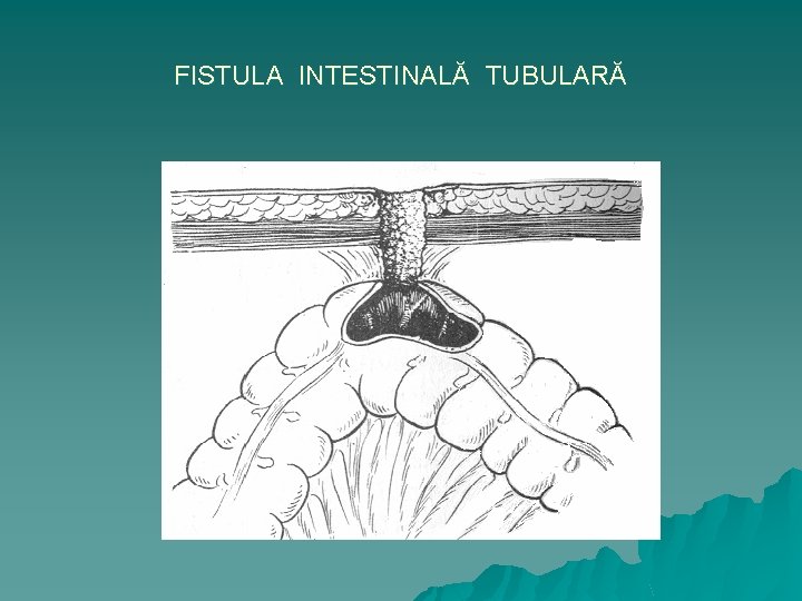 FISTULA INTESTINALĂ TUBULARĂ 