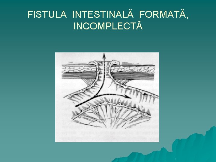 FISTULA INTESTINALĂ FORMATĂ, INCOMPLECTĂ 