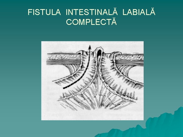 FISTULA INTESTINALĂ LABIALĂ COMPLECTĂ 