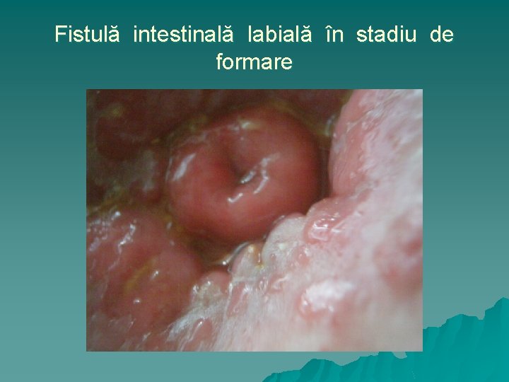 Fistulă intestinală labială în stadiu de formare 