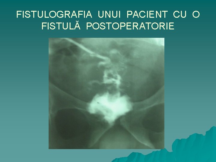 FISTULOGRAFIA UNUI PACIENT CU O FISTULĂ POSTOPERATORIE 