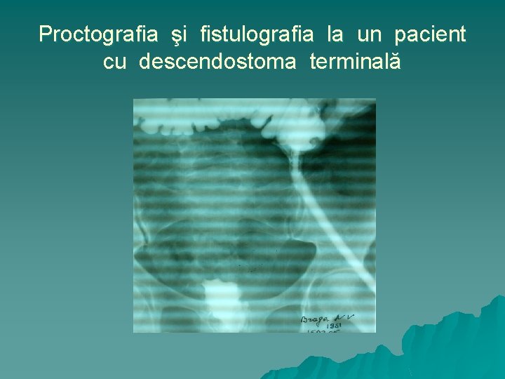 Proctografia şi fistulografia la un pacient cu descendostoma terminală 