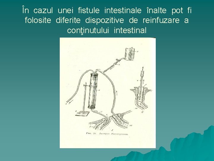 În cazul unei fistule intestinale înalte pot fi folosite diferite dispozitive de reinfuzare a