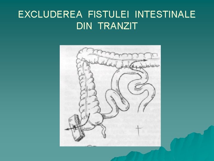 EXCLUDEREA FISTULEI INTESTINALE DIN TRANZIT 