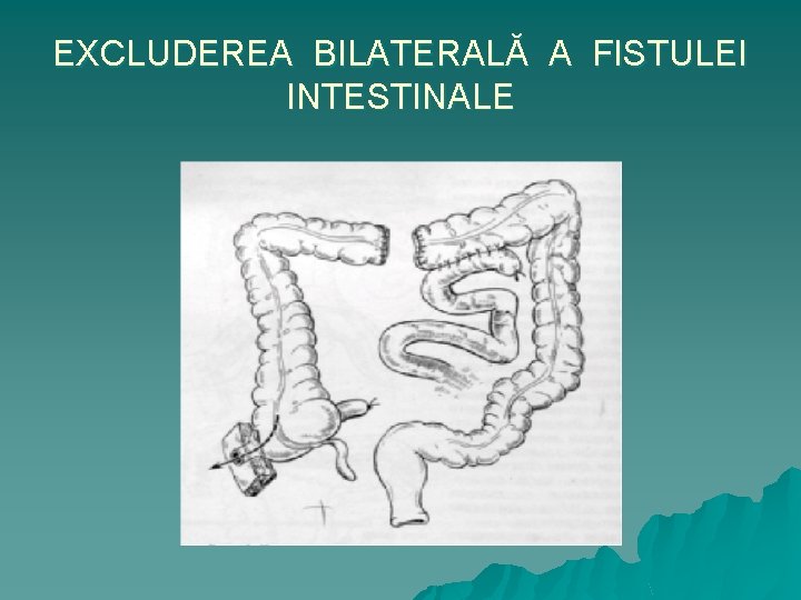 EXCLUDEREA BILATERALĂ A FISTULEI INTESTINALE 