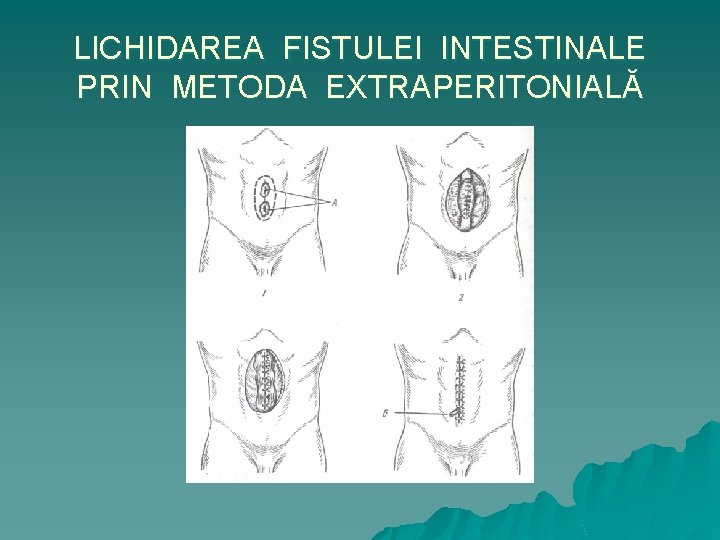 LICHIDAREA FISTULEI INTESTINALE PRIN METODA EXTRAPERITONIALĂ 