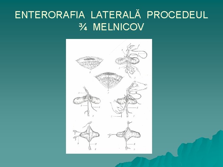 ENTERORAFIA LATERALĂ PROCEDEUL ¾ MELNICOV 