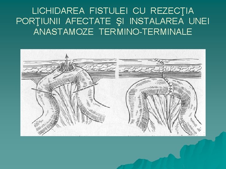 LICHIDAREA FISTULEI CU REZECŢIA PORŢIUNII AFECTATE ŞI INSTALAREA UNEI ANASTAMOZE TERMINO-TERMINALE 