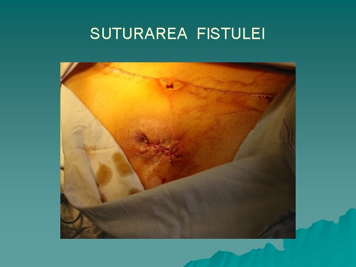 SUTURAREA FISTULEI 