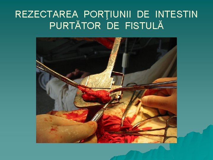 REZECTAREA PORŢIUNII DE INTESTIN PURTĂTOR DE FISTULĂ 