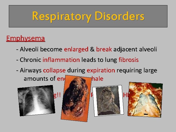 Respiratory Disorders Emphysema - Alveoli become enlarged & break adjacent alveoli - Chronic inflammation