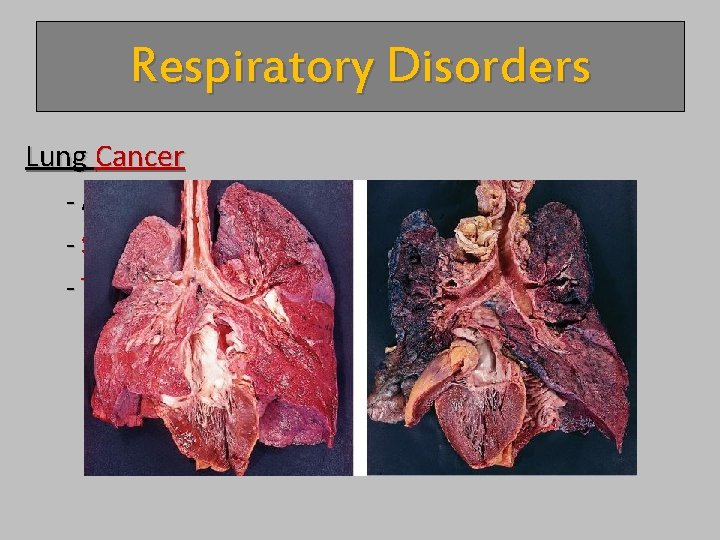 Respiratory Disorders Lung Cancer - Accounts for 1/3 of all cancer deaths in U.