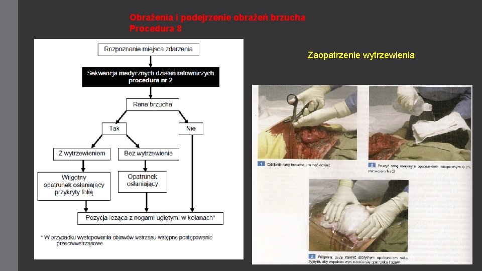 Obrażenia i podejrzenie obrażeń brzucha Procedura 8 Zaopatrzenie wytrzewienia 