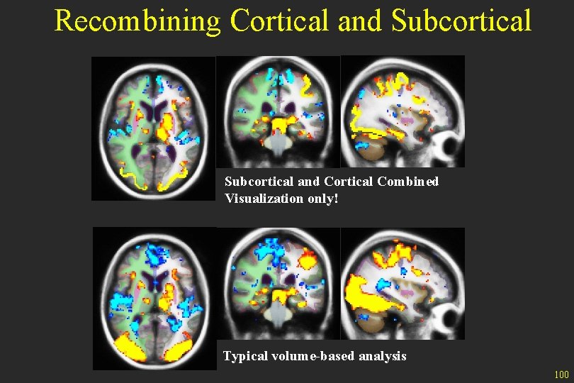 Recombining Cortical and Subcortical and Cortical Combined Visualization only! Typical volume-based analysis 100 