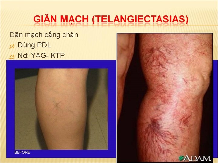 Dãn mạch cẳng chân Dùng PDL Nd: YAG- KTP 