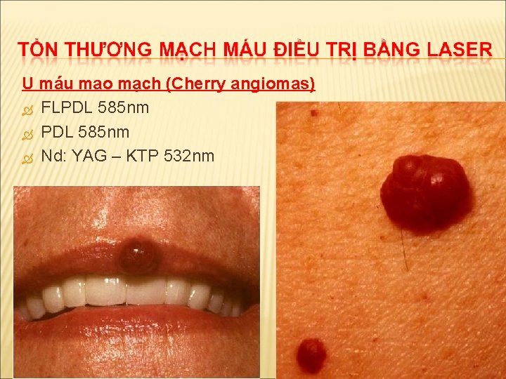 U máu mao mạch (Cherry angiomas) FLPDL 585 nm Nd: YAG – KTP 532