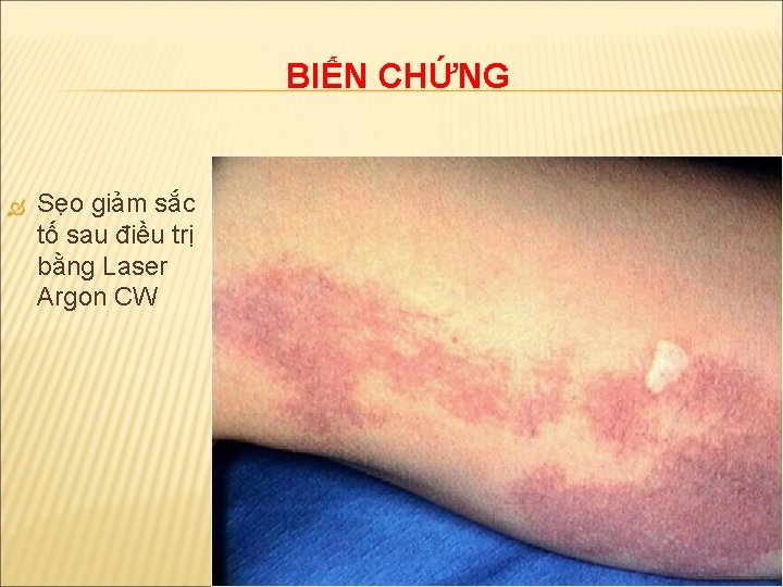 BIẾN CHỨNG Sẹo giảm sắc tố sau điều trị bằng Laser Argon CW 