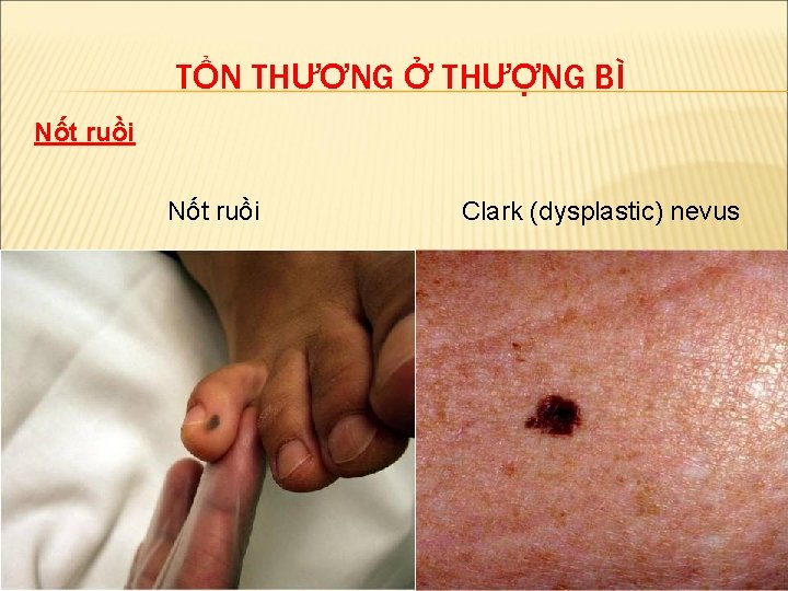 TỔN THƯƠNG Ở THƯỢNG BÌ Nốt ruồi Clark (dysplastic) nevus 