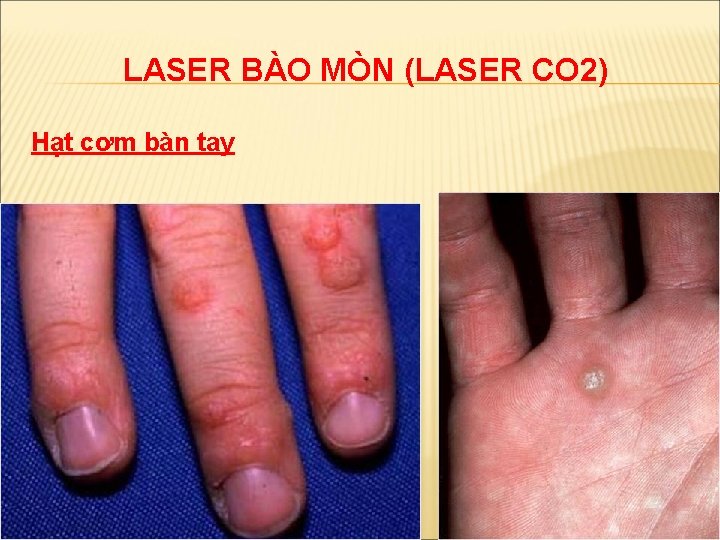 LASER BÀO MÒN (LASER CO 2) Hạt cơm bàn tay 