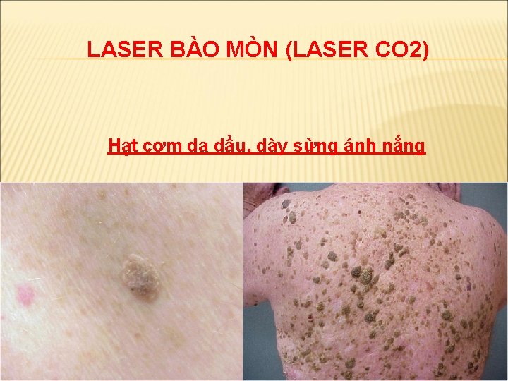 LASER BÀO MÒN (LASER CO 2) Hạt cơm da dầu, dày sừng ánh nắng