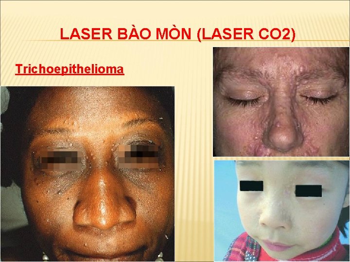 LASER BÀO MÒN (LASER CO 2) Trichoepithelioma 