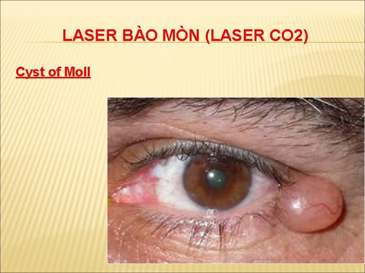 LASER BÀO MÒN (LASER CO 2) Cyst of Moll 