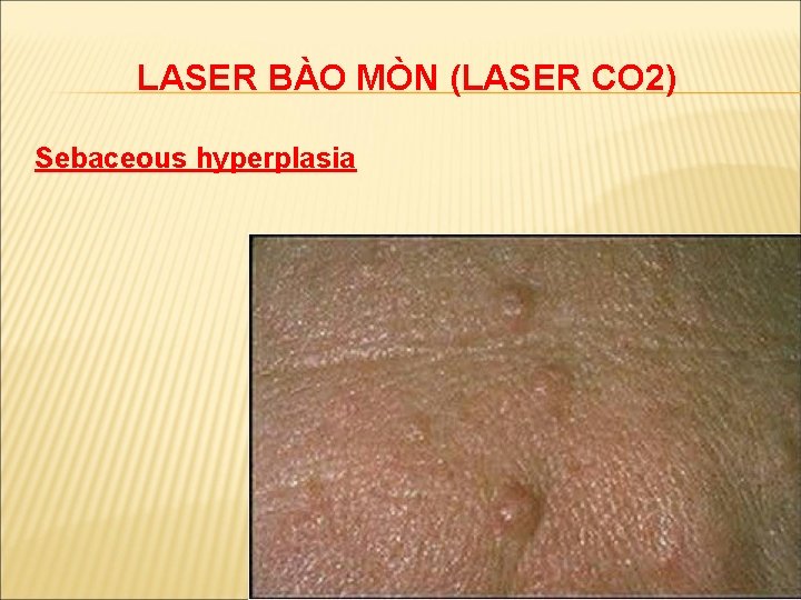 LASER BÀO MÒN (LASER CO 2) Sebaceous hyperplasia 