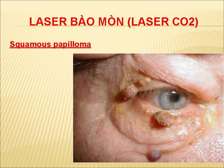 LASER BÀO MÒN (LASER CO 2) Squamous papilloma 