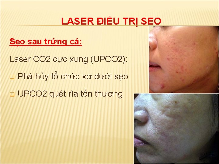 LASER ĐIỀU TRỊ SẸO Sẹo sau trứng cá: Laser CO 2 cực xung (UPCO