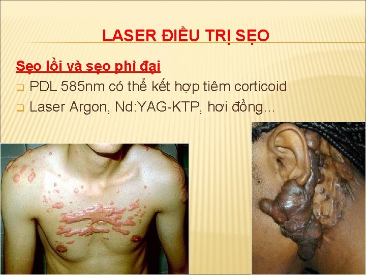 LASER ĐIỀU TRỊ SẸO Sẹo lồi và sẹo phì đại q PDL 585 nm