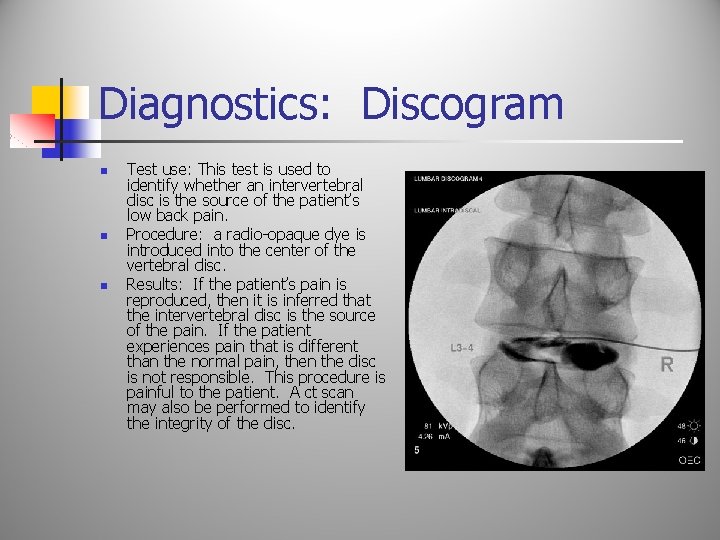 Diagnostics: Discogram n n n Test use: This test is used to identify whether