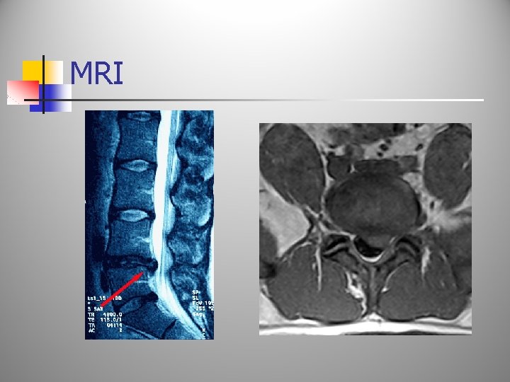 MRI 