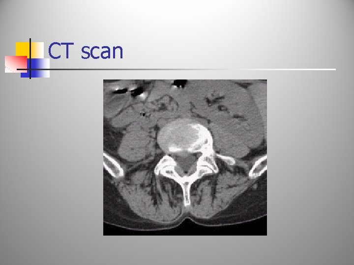 CT scan 