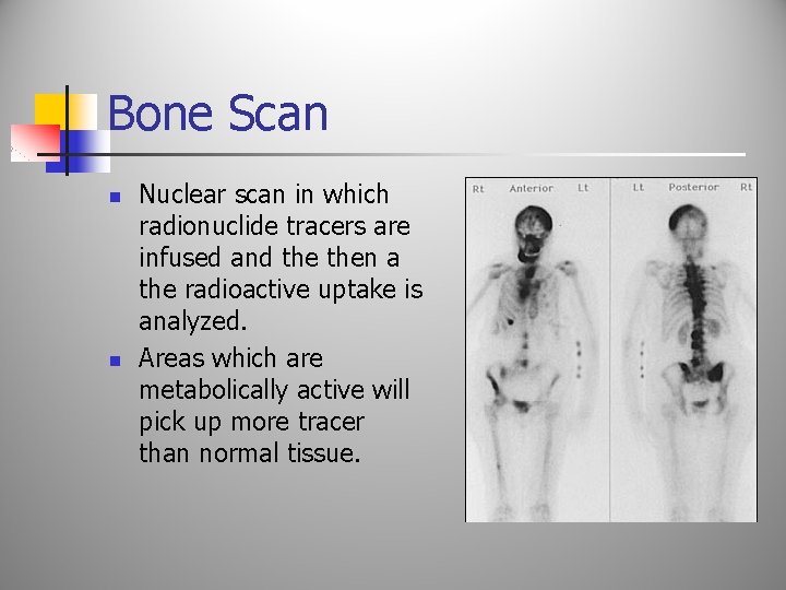 Bone Scan n n Nuclear scan in which radionuclide tracers are infused and then
