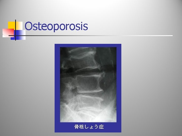 Osteoporosis 