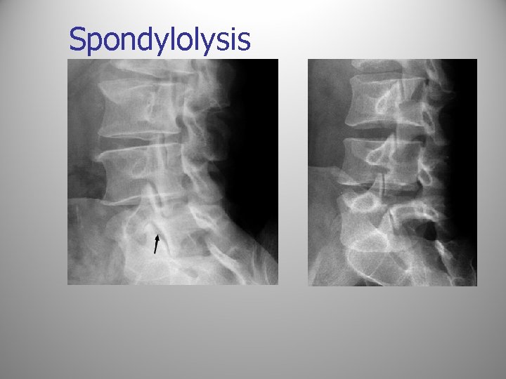 Spondylolysis 
