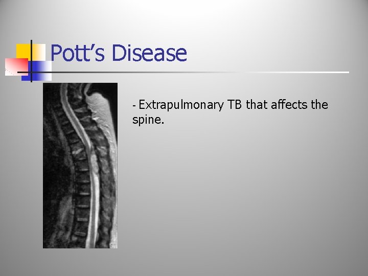 Pott’s Disease Extrapulmonary TB that affects the spine. - 
