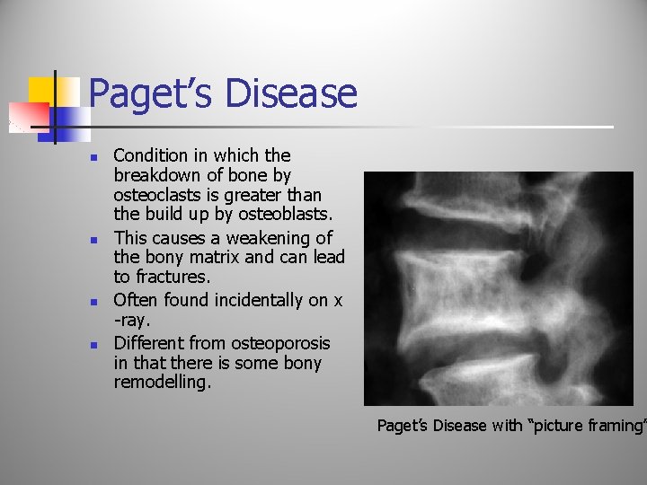 Paget’s Disease n n Condition in which the breakdown of bone by osteoclasts is