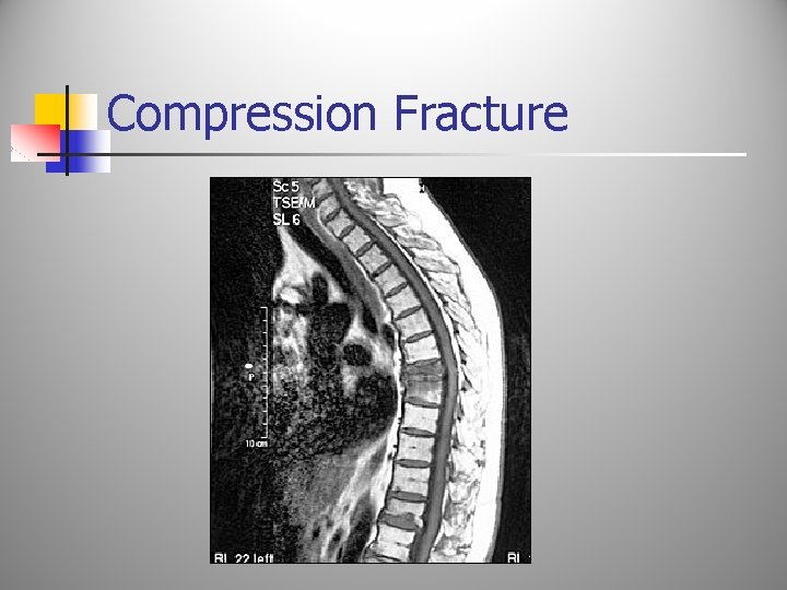 Compression Fracture 