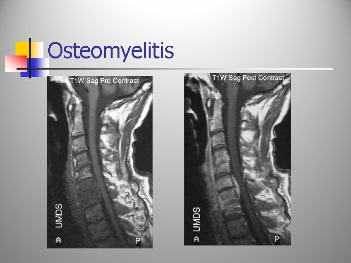 Osteomyelitis 