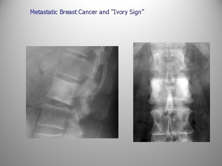 Metastatic Breast Cancer and “Ivory Sign” 
