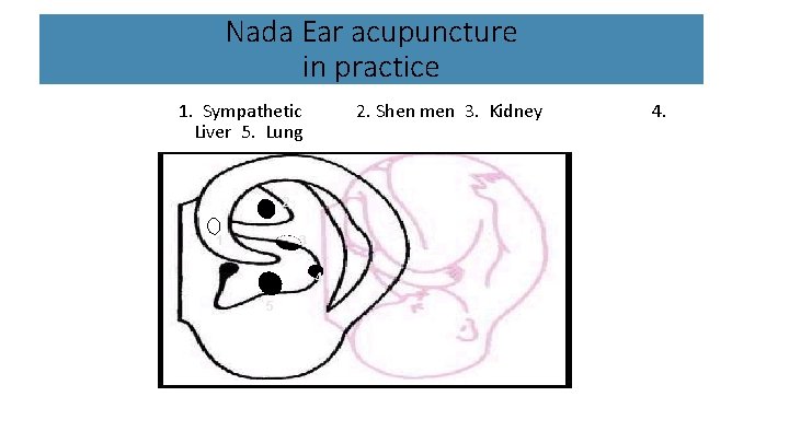 Nada Ear acupuncture in practice 1. Sympathetic Liver 5. Lung 2. Shen men 3.